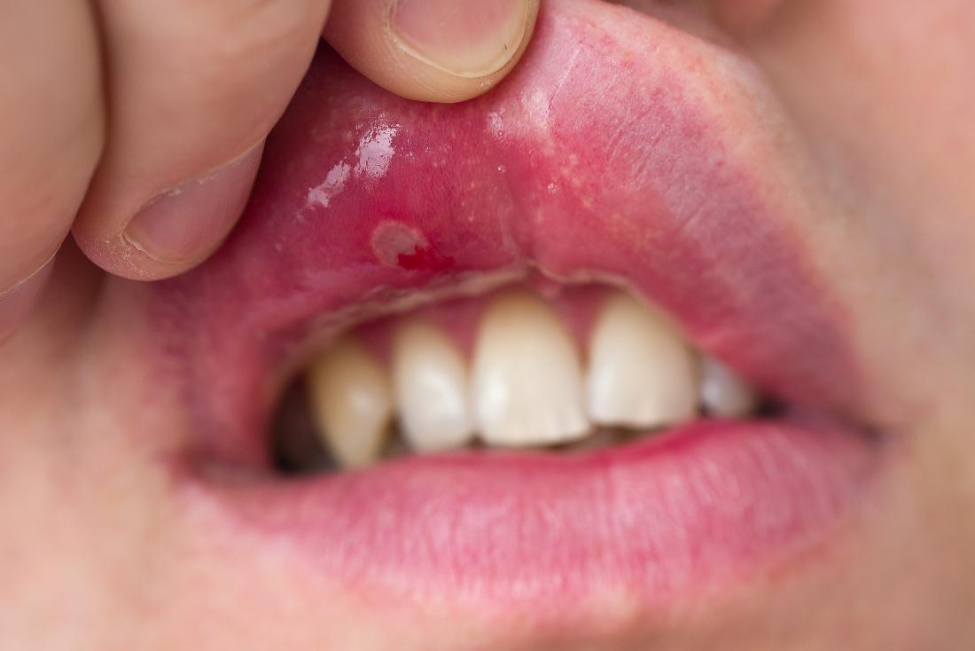 pessoa levantando o lábio para mostrar úlcera na boca