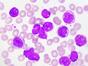 Cellules leucémiques lymphoblastiques aiguës