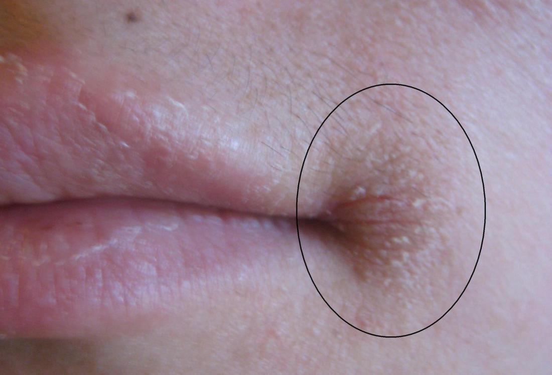 Viêm môi góc. Hình ảnh tín dụng: James Heilman, MD, (2009, 8 tháng 11)