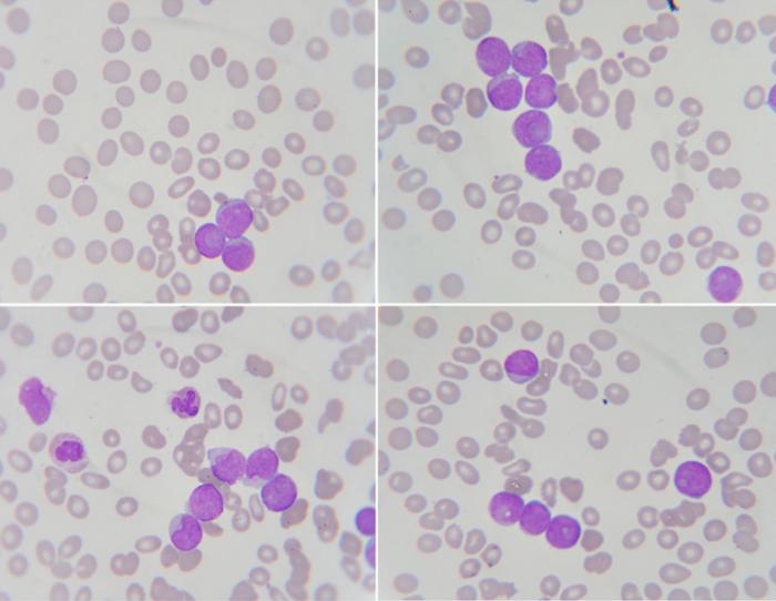 Blutausstrich mit Neutrophilen, weißen Blutkörperchen und Leukämie