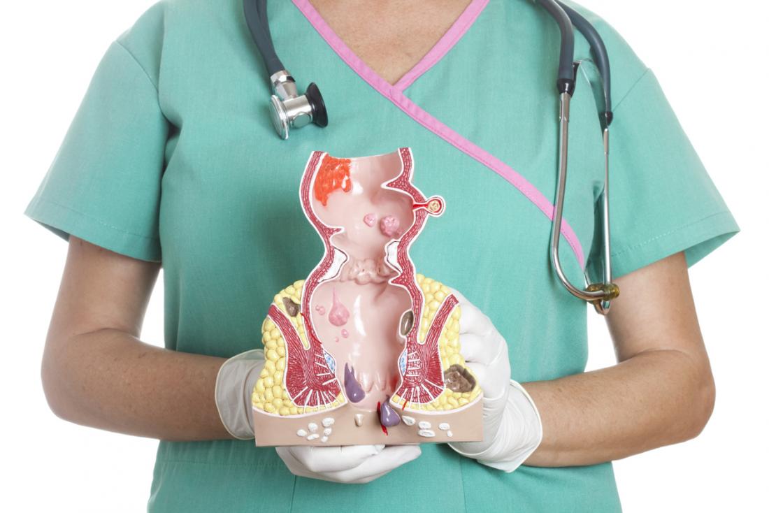 Infirmière tenant le modèle du rectum et de l'anus.