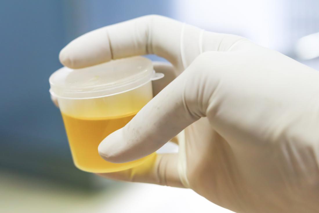 Mano inguantata del tecnico di laboratorio che tiene il campione di urina in un vaso trasparente.