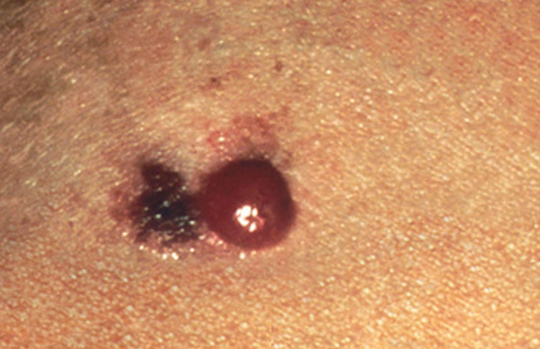 Amelanotik melanom