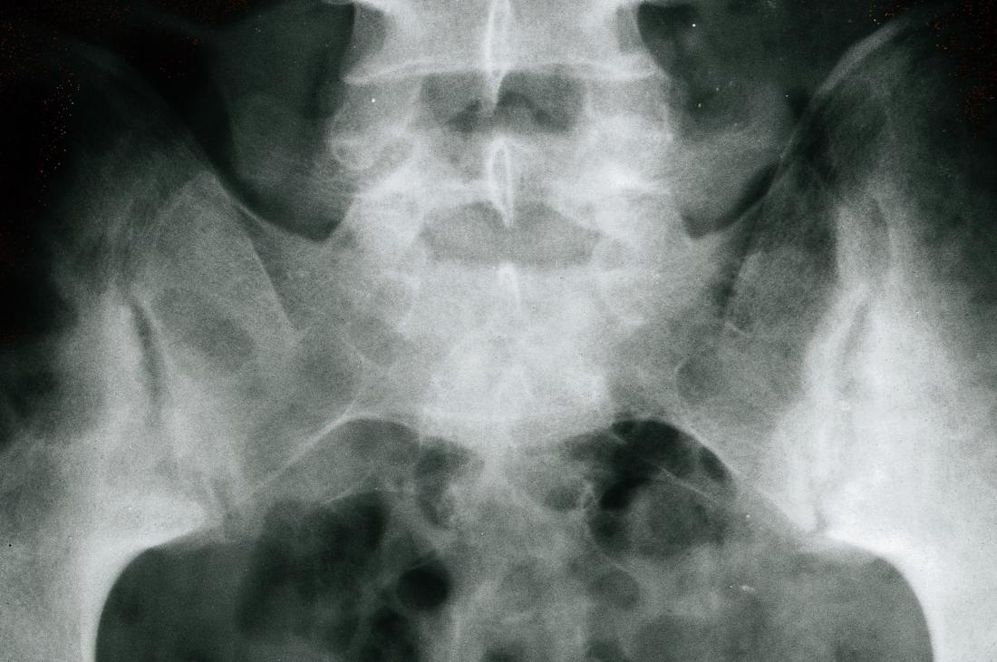 [仙腸関節を融合させた強直性脊椎炎のX線写真（Wellcome Images）]