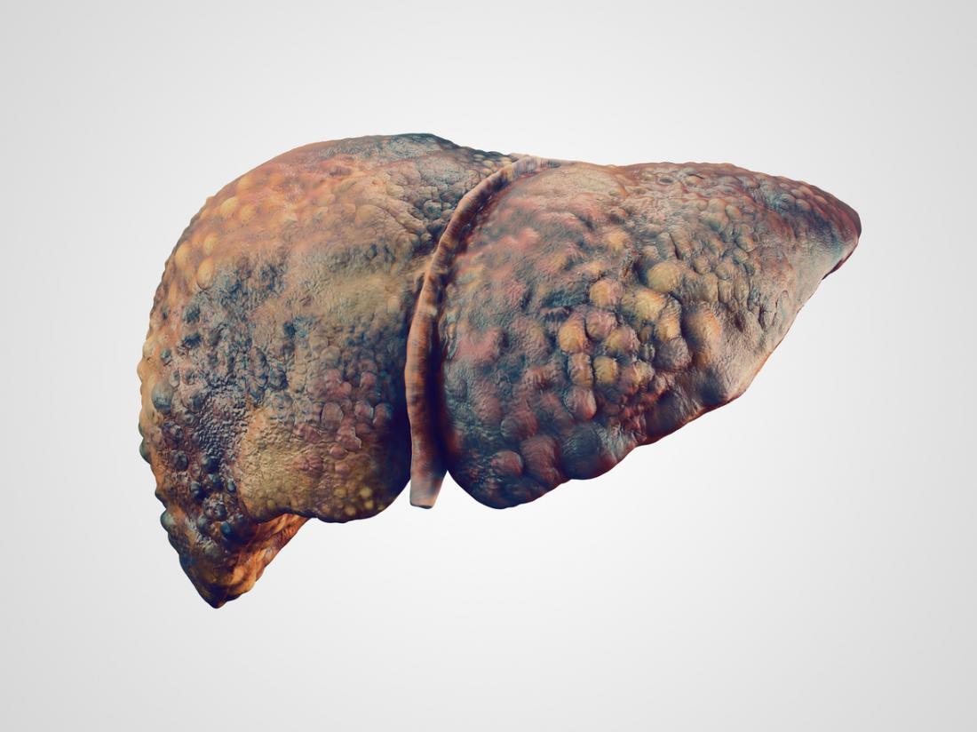 Fígado Ascites