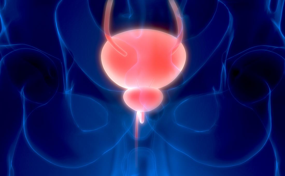 膀胱痙攣を表す、体の3D画像で強調された膀胱