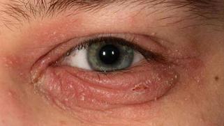 眼瞼炎。イメージクレジット：DermNetニュージーランド