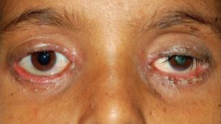Blepharitis. Indian Journal of Ophthalmology über openi.nlm.nih.gov