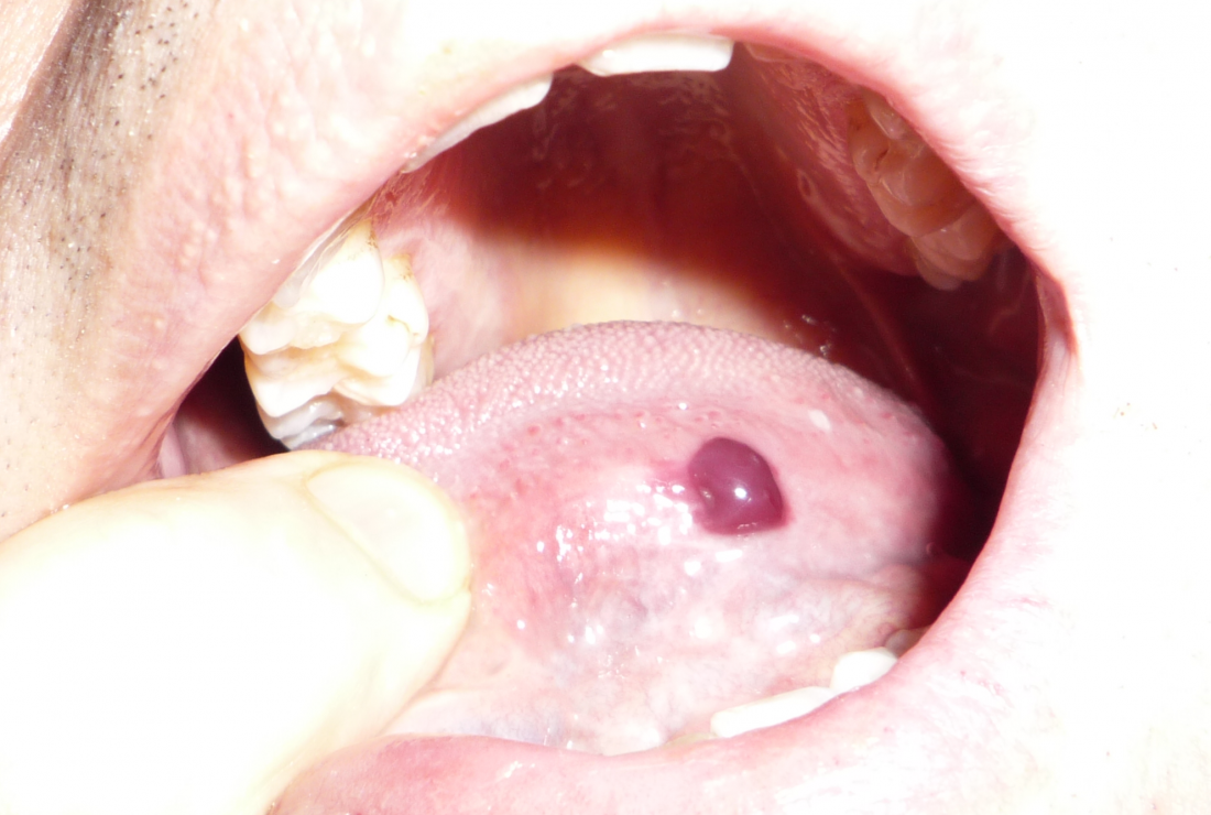 Кръвен блистер в устата, причинен от кръвоизлив от стенокардия. Книга за изображението: Angus Johnson, (2013, 1 май)