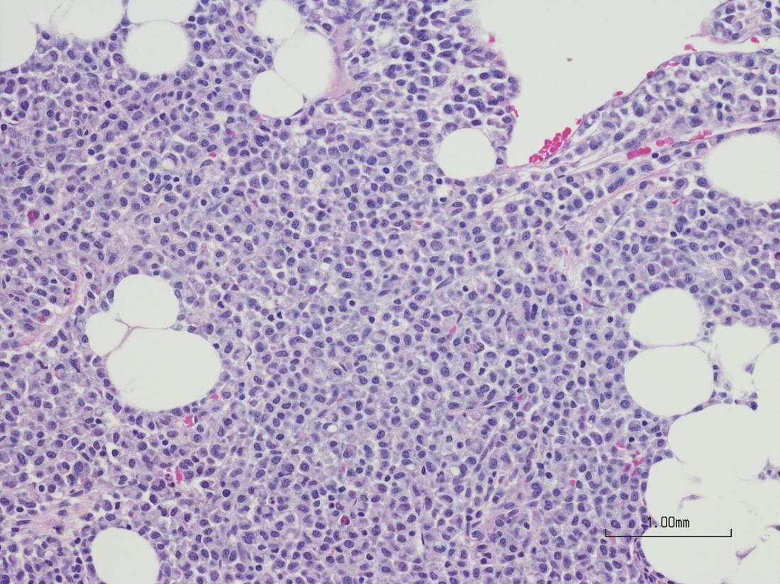 mieloma de células plasmáticas da biópsia da medula óssea