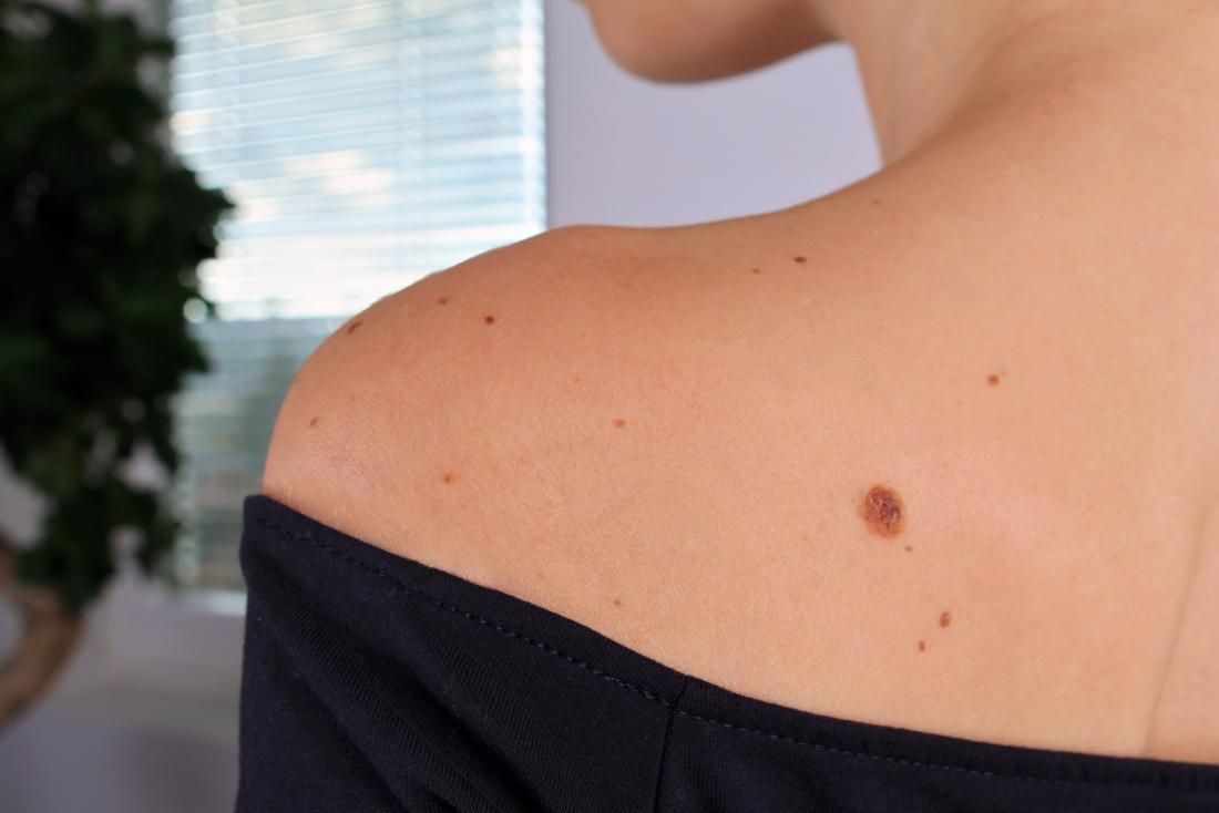 Moles e marcas de nascença no ombro da mulher.