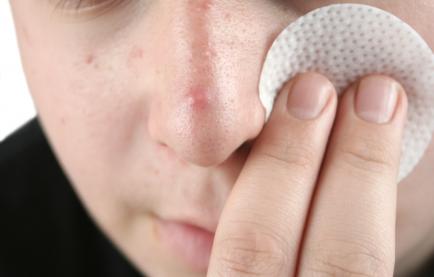 Trattamento dell'acne all'olio di jojoba applicato sul viso