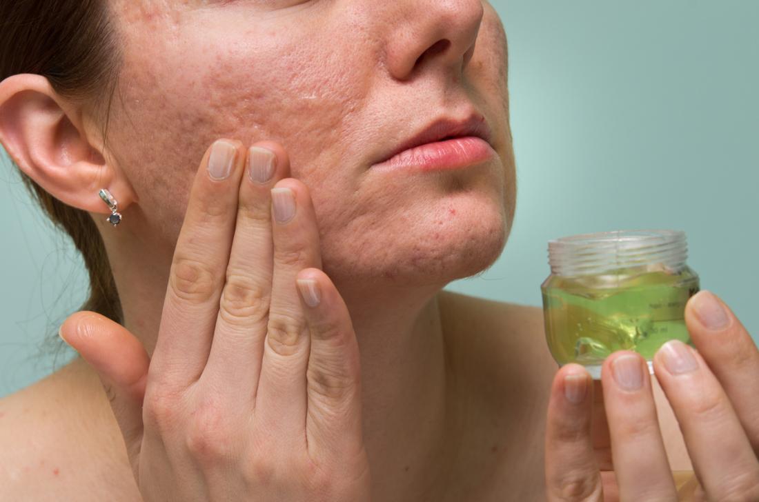L'aloe vera è un'alternativa all'olio di jojoba per l'acne