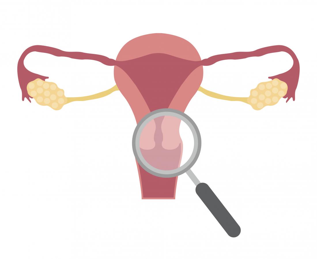 Nahaufnahme des Gebärmutterhalses - Cervical Ektropium