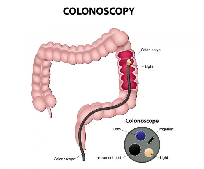 Um diagrama da colonoscopia