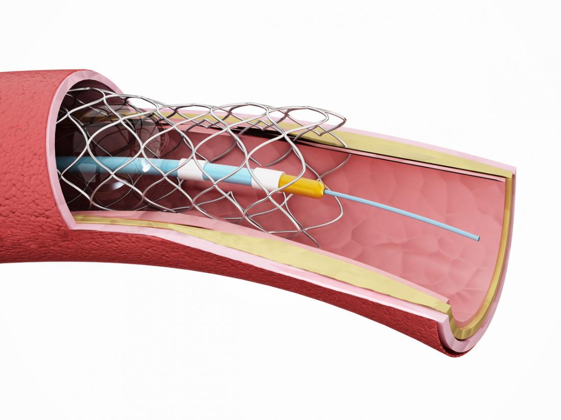Una maglia inserita all'interno di un'arteria