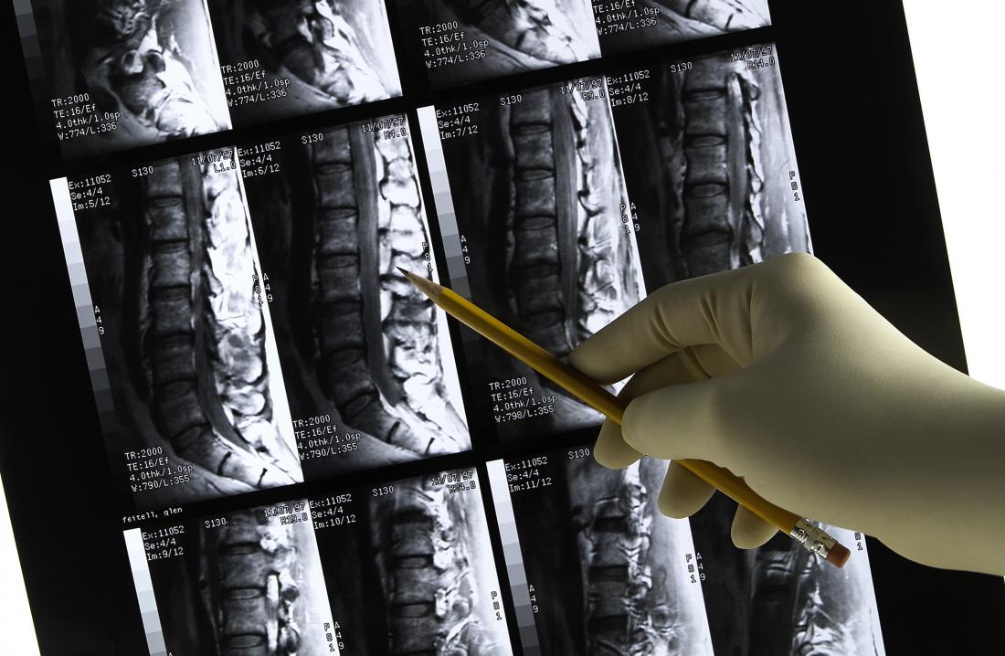 Рентгенови лъчи на гръбнака, показващи херния диск.