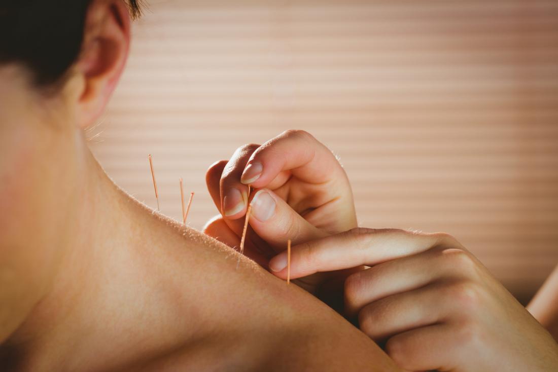 Femme recevant l'acupuncture sur son épaule.