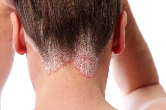 Bệnh vẩy nến trên cơ sở của một da đầu nữ