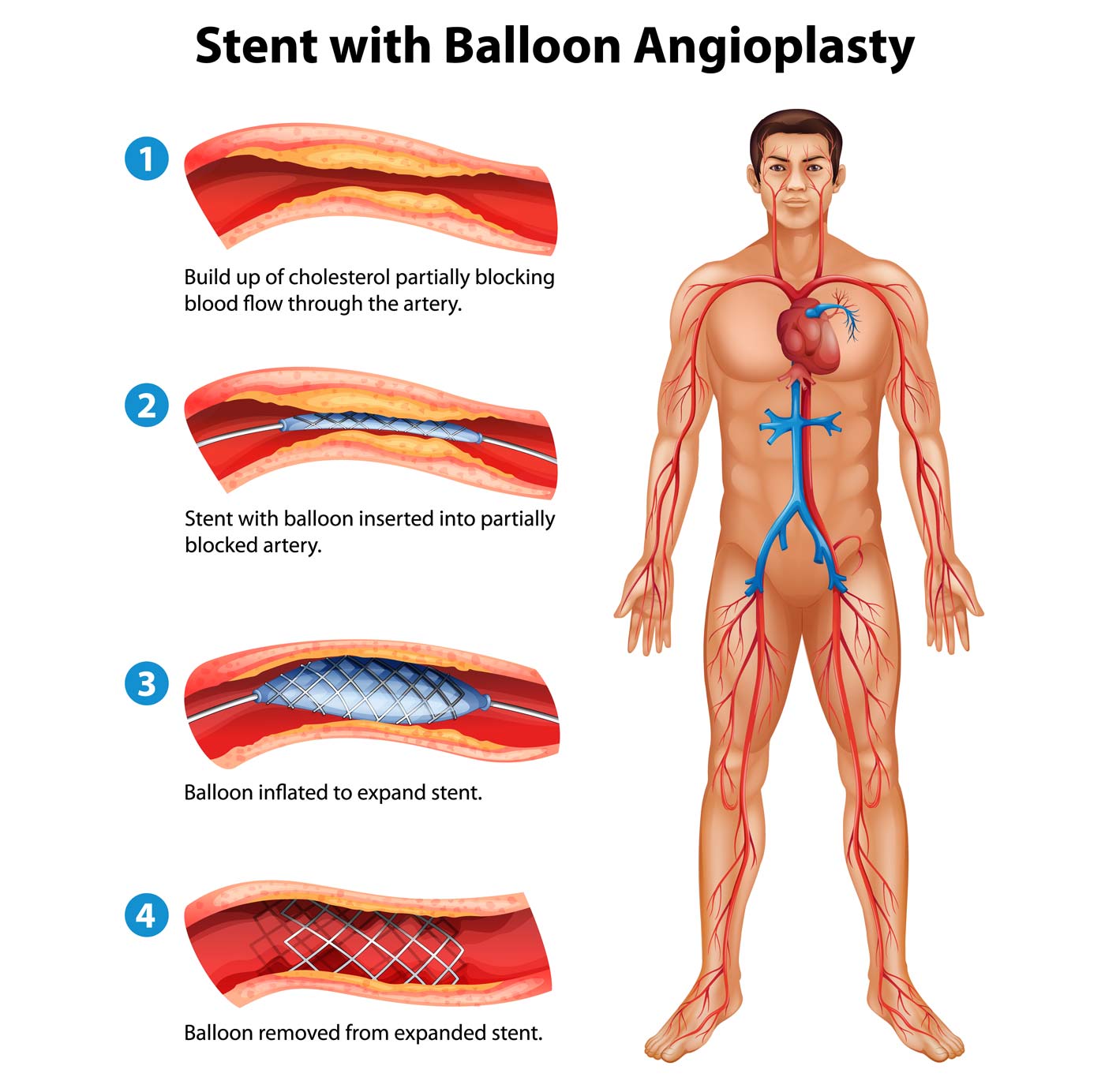 Schema di uno stent con procedura di angioplastica con palloncino