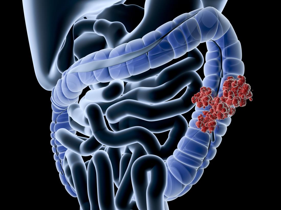 Il cancro del colon colpisce l'intestino crasso. Di solito si sviluppa da polipi benigni.