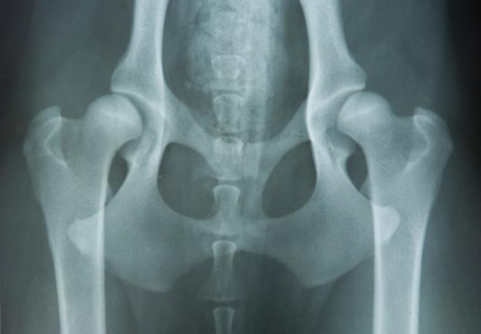 Рентгеново изображение, показващо тазобедрена дисплазия.