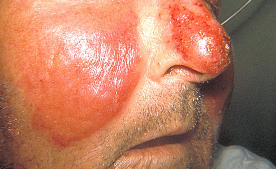 Erisipela facciale wikicommons CDC / Dr. Thomas F. Sellers / Emory University