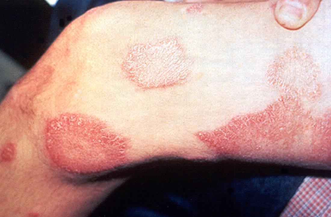 Lepra lezyonları