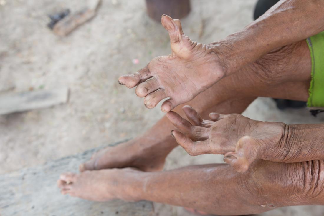 Leprosy curling parmakları