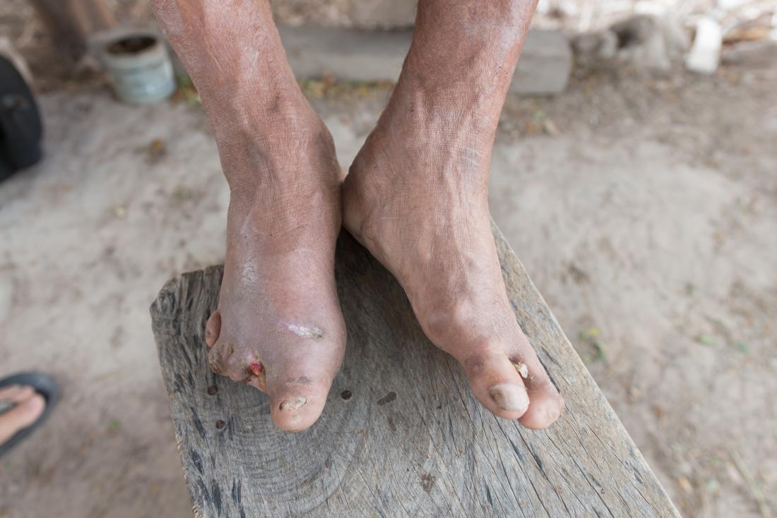 Leprosy uzuv hasarı