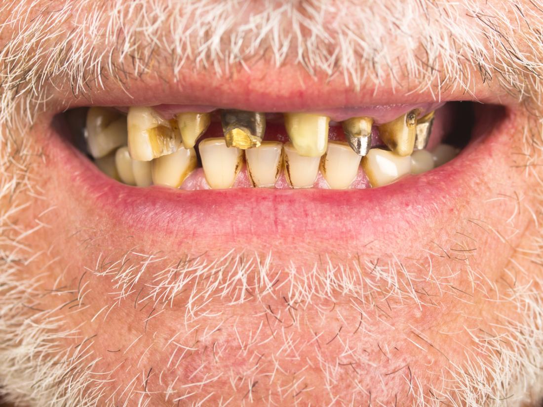 Denti di scorbuto
