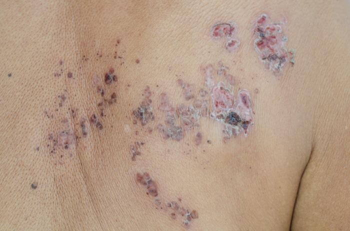 Croste di herpes zoster.