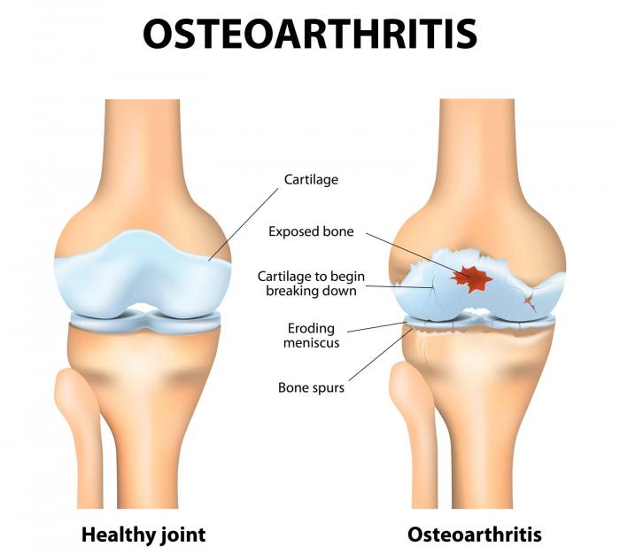 Диаграма на остеоартроза на коляното.
