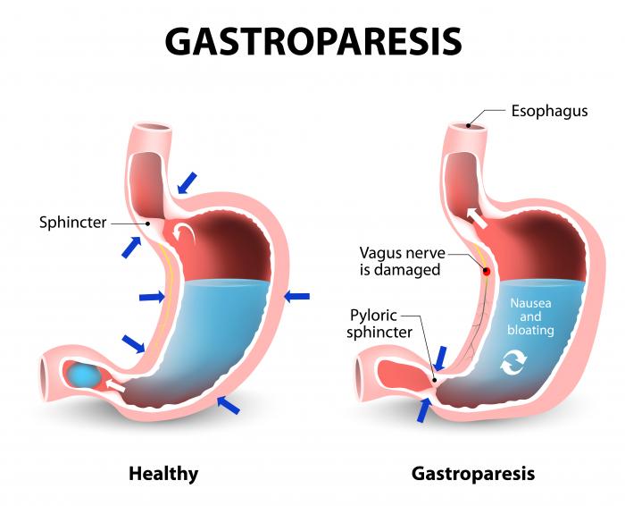 Gastroparezi etkilerini gösteren iki mideyi gösteren bir diyagram