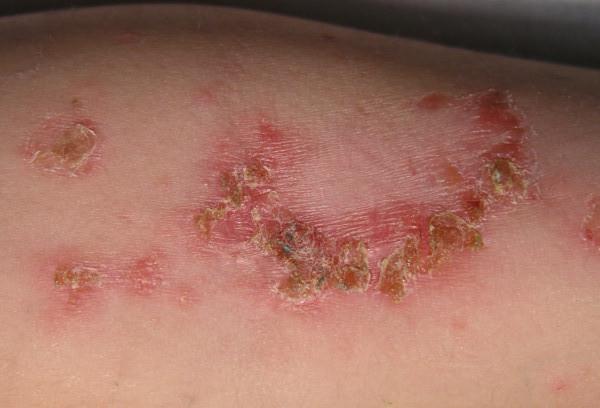 [impetigine hiv lesions on gomito credit wikicommons evanherk 2004]