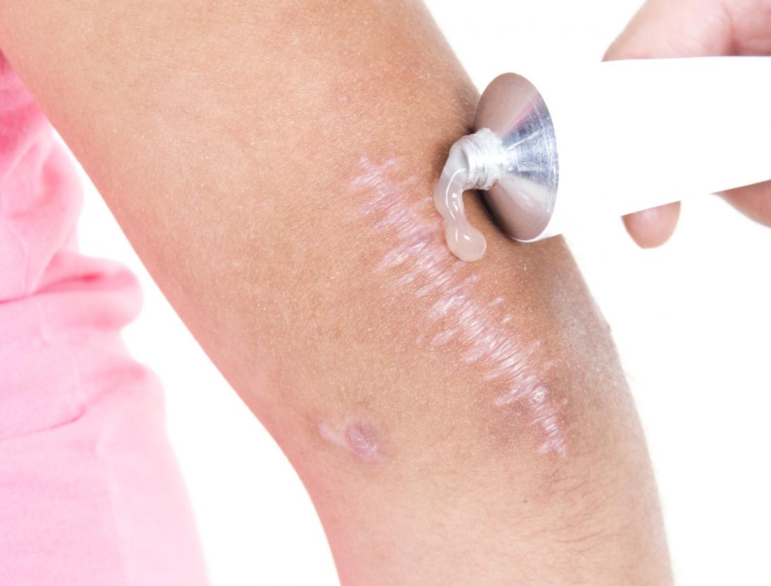Applicazione di unguento in gel alla pelle per aiutare a guarire una cicatrice.