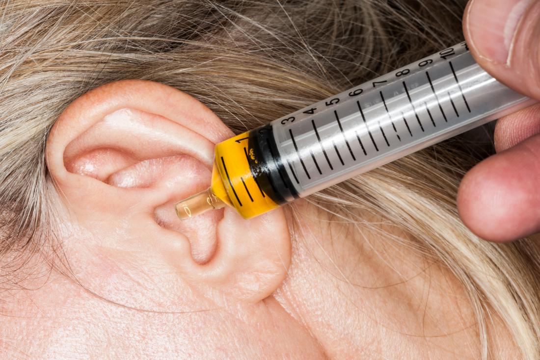 Le gocce d'olio di olio nella siringa vengono dispensate nell'orecchio otturato.