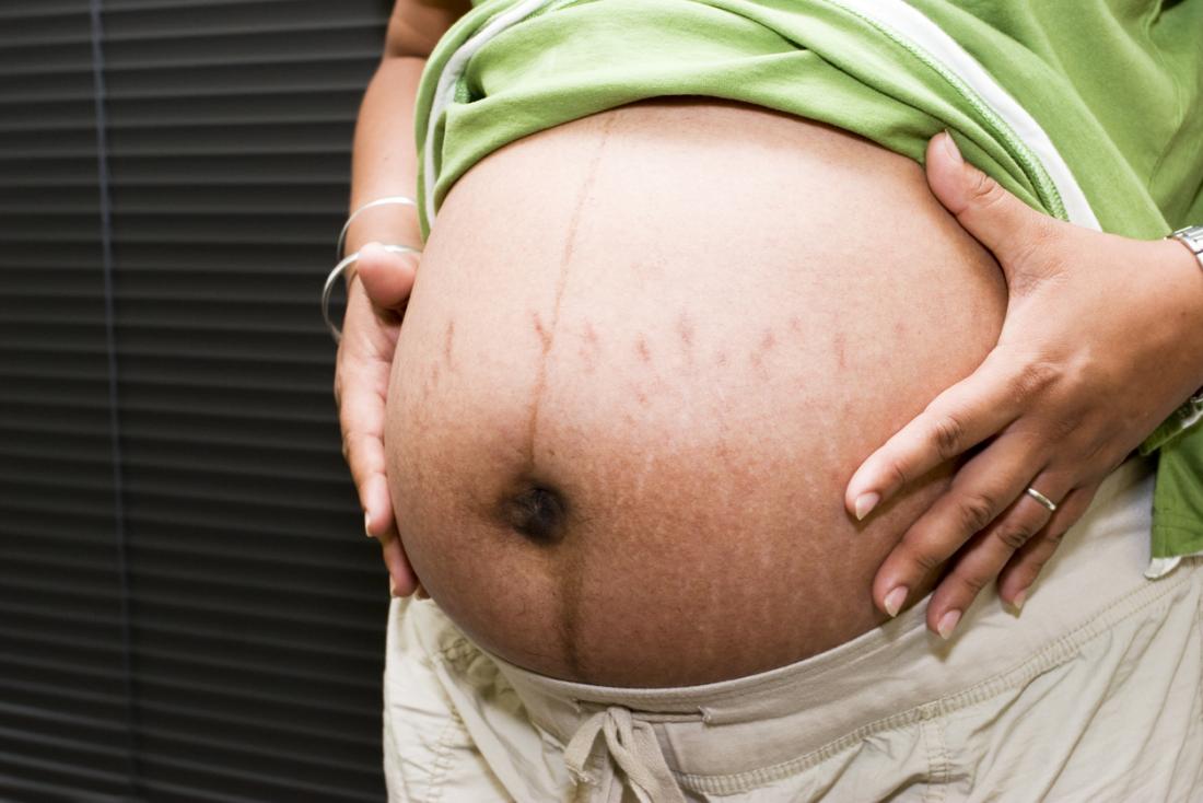 Бременността е една от основните причини за стрии.