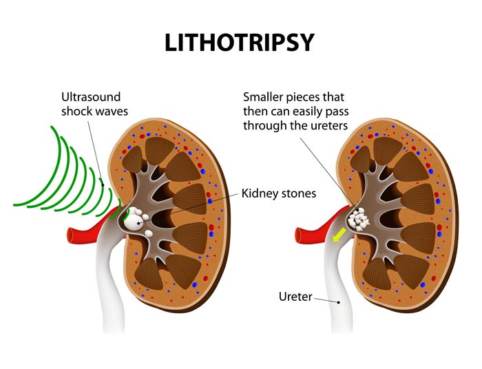 Trattamento di litotripsia per calcoli renali