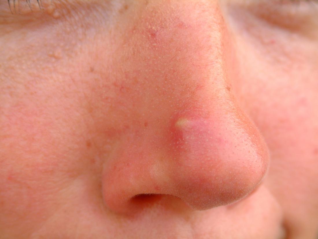 Acne naso