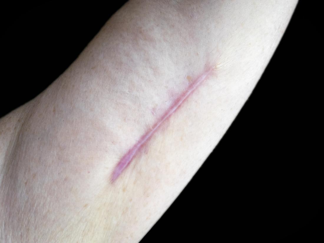 cicatrice chéloïde sur le bras