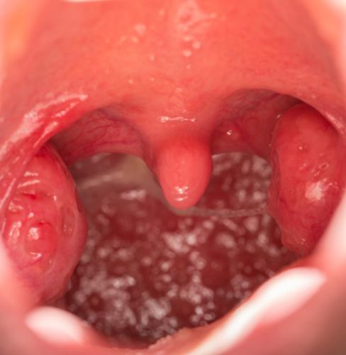 Tonsille in gola
