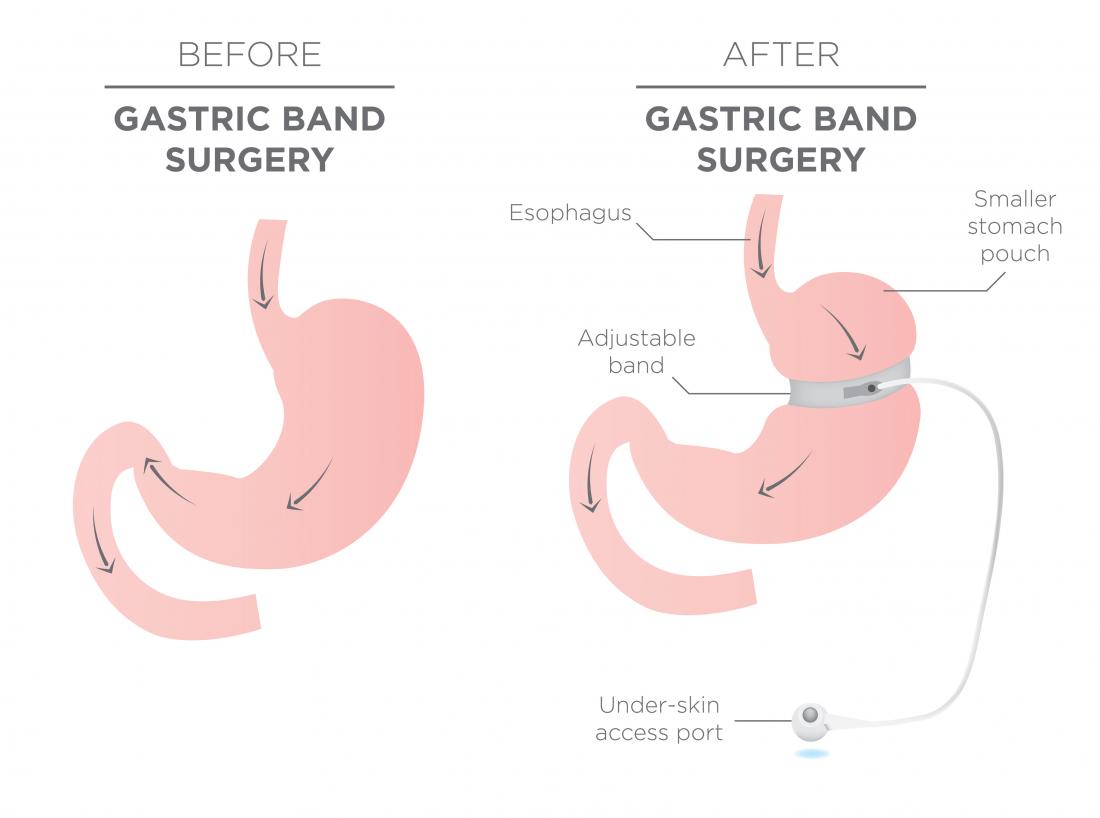 Chirurgia della fascia gastrica