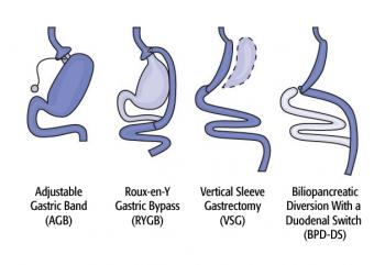 диаграма на хирургични стомашни опции