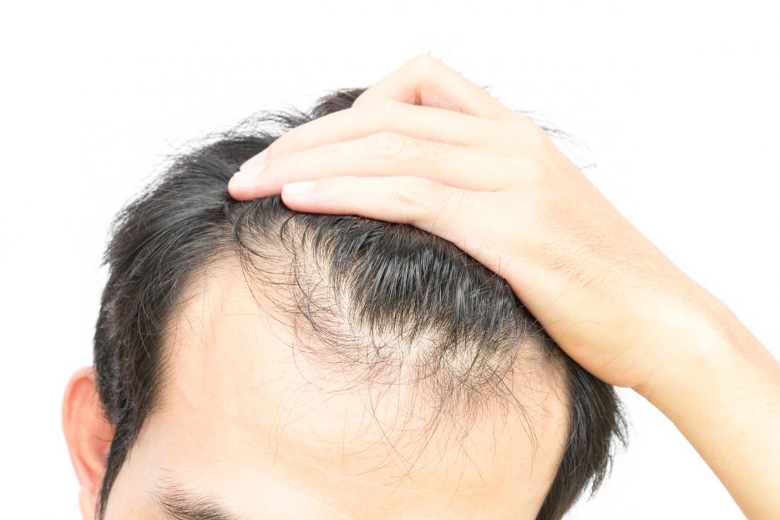 Haarausfall, Haarausfall und Ausdünnung bei einem jungen Mann.