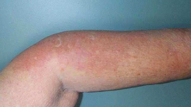неутрофилна дерматоза, свързана с ревматоиден артрит