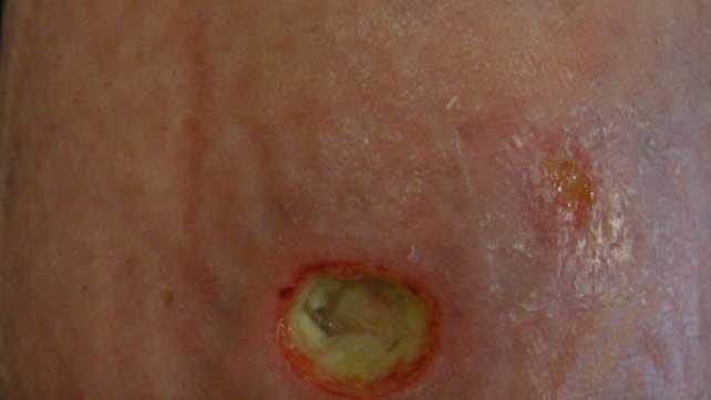 Ulcera sulla pelle