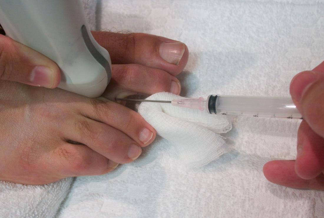 Iniezione di steroidi viene dato tra le dita dei piedi di una persona.