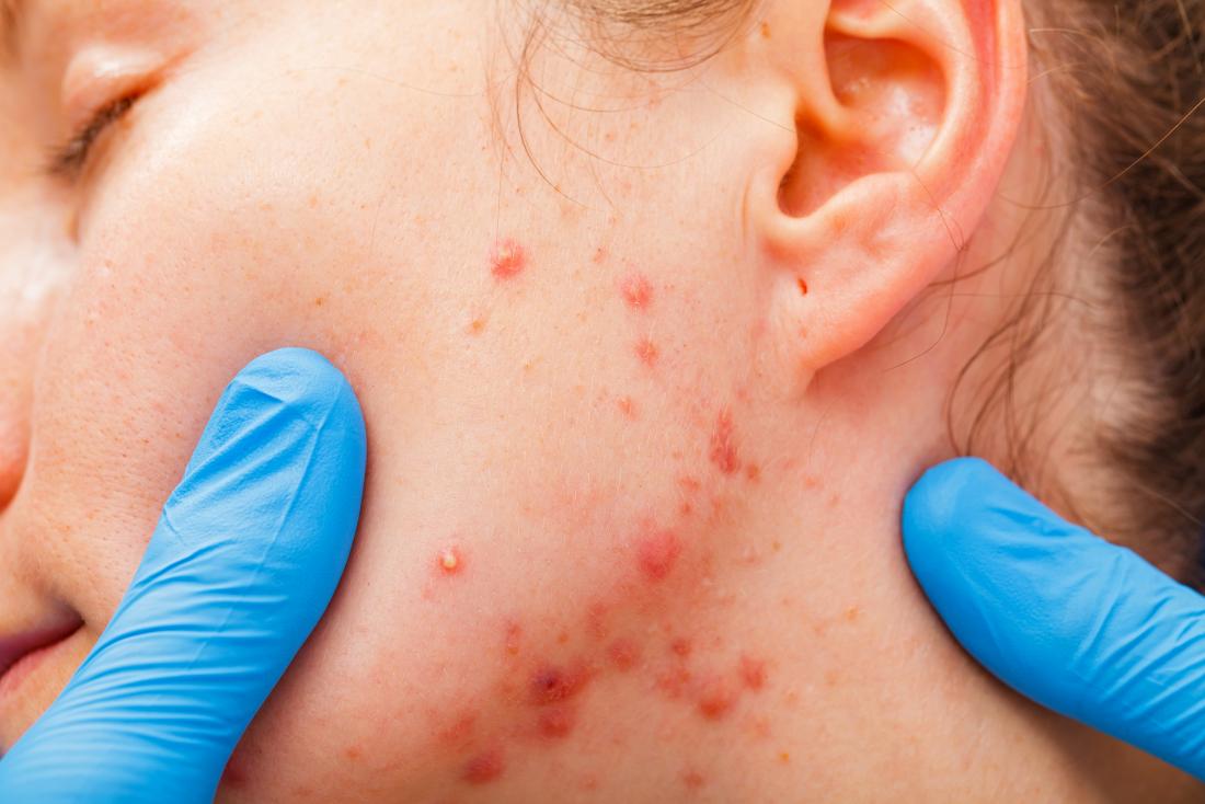 Dermatologista com mãos enluvadas inspecionando acne inflamada no rosto do paciente.