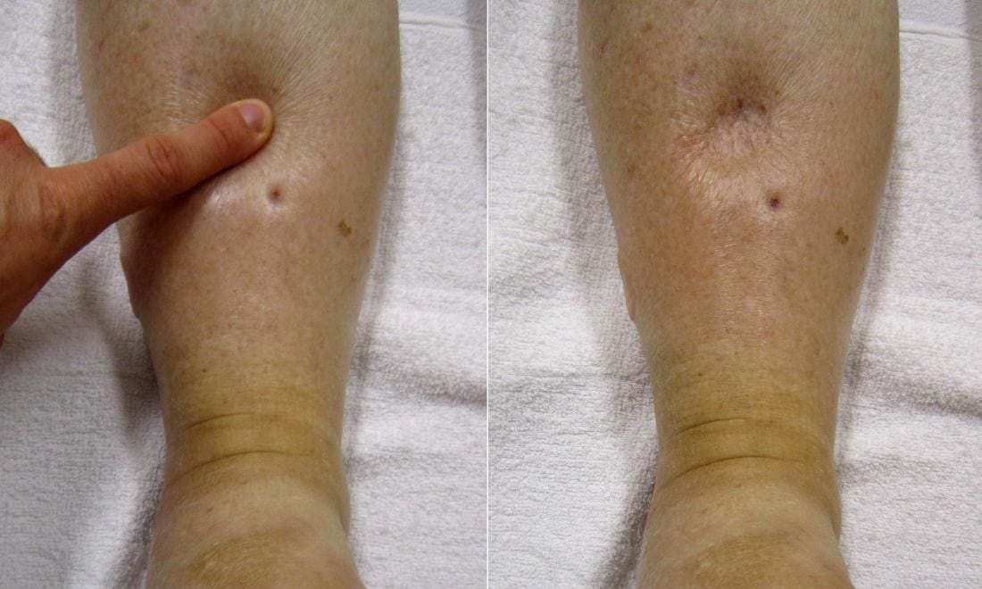 Pitting edema. Crédito da imagem: James Heilman, MD, (2017, 1 de fevereiro).